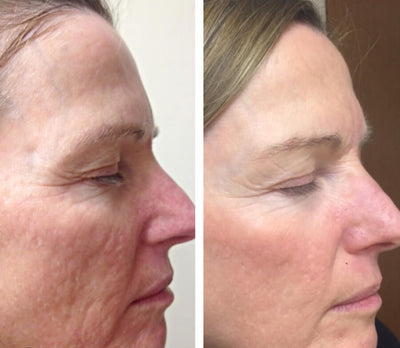 3 Micro-needling Treatments w/ PRF Or  Exosomes Package