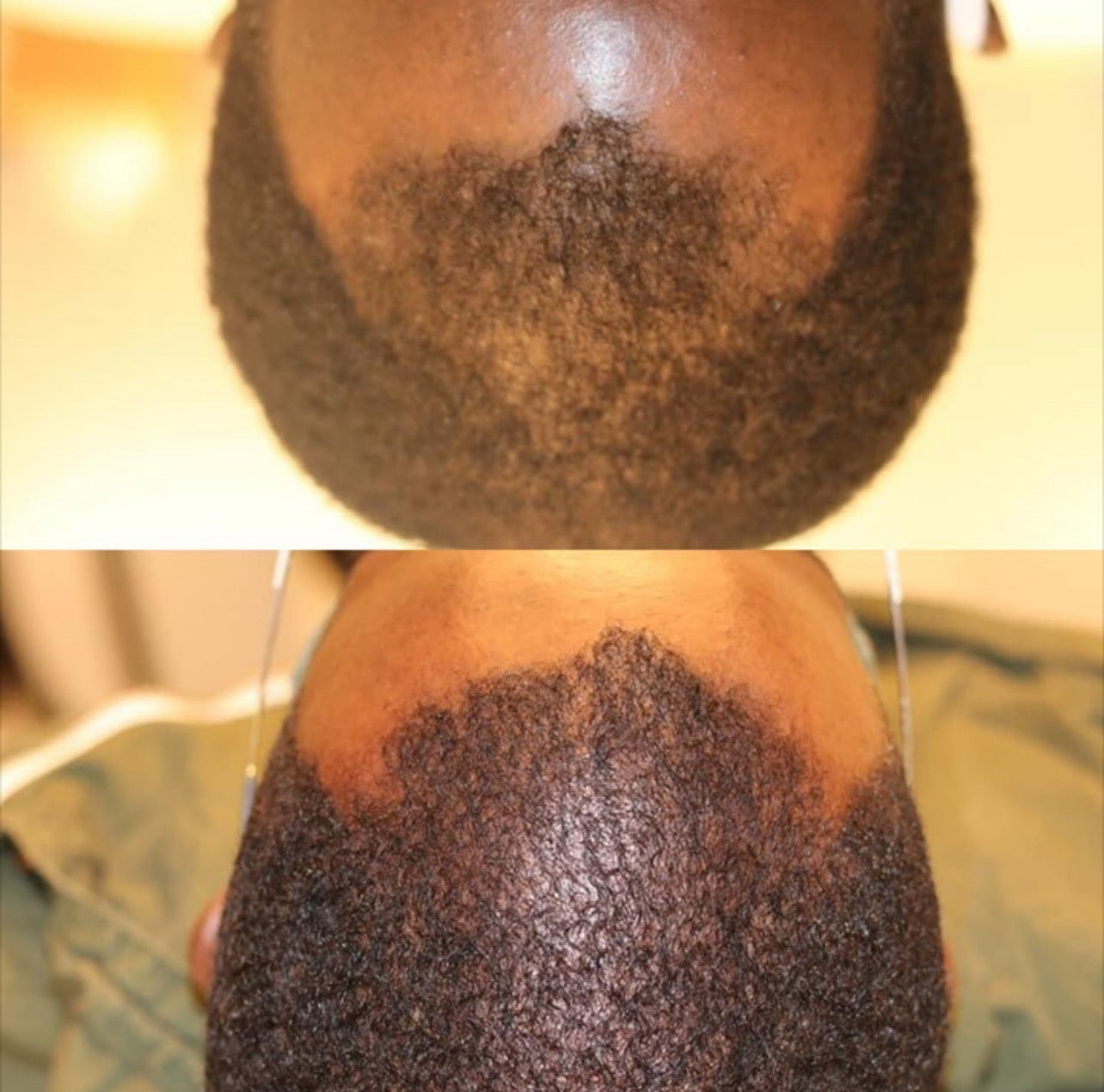Hair Restoration Treatment- 1 Treatment