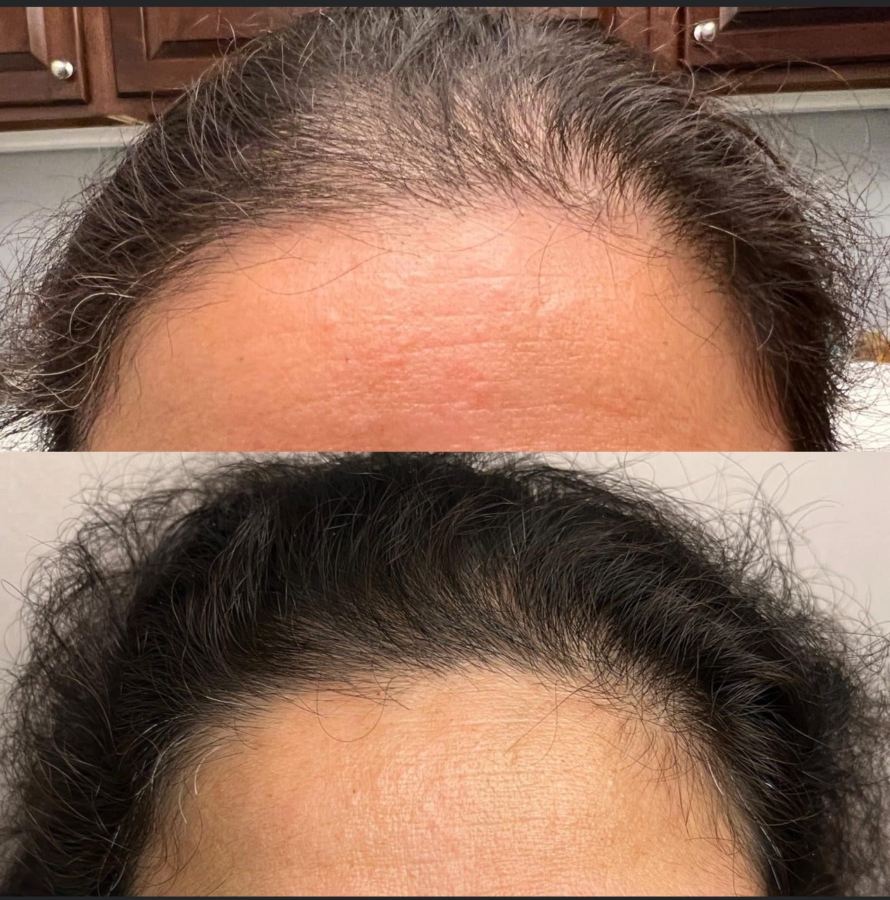 Hair Restoration Treatment -3 Treatments