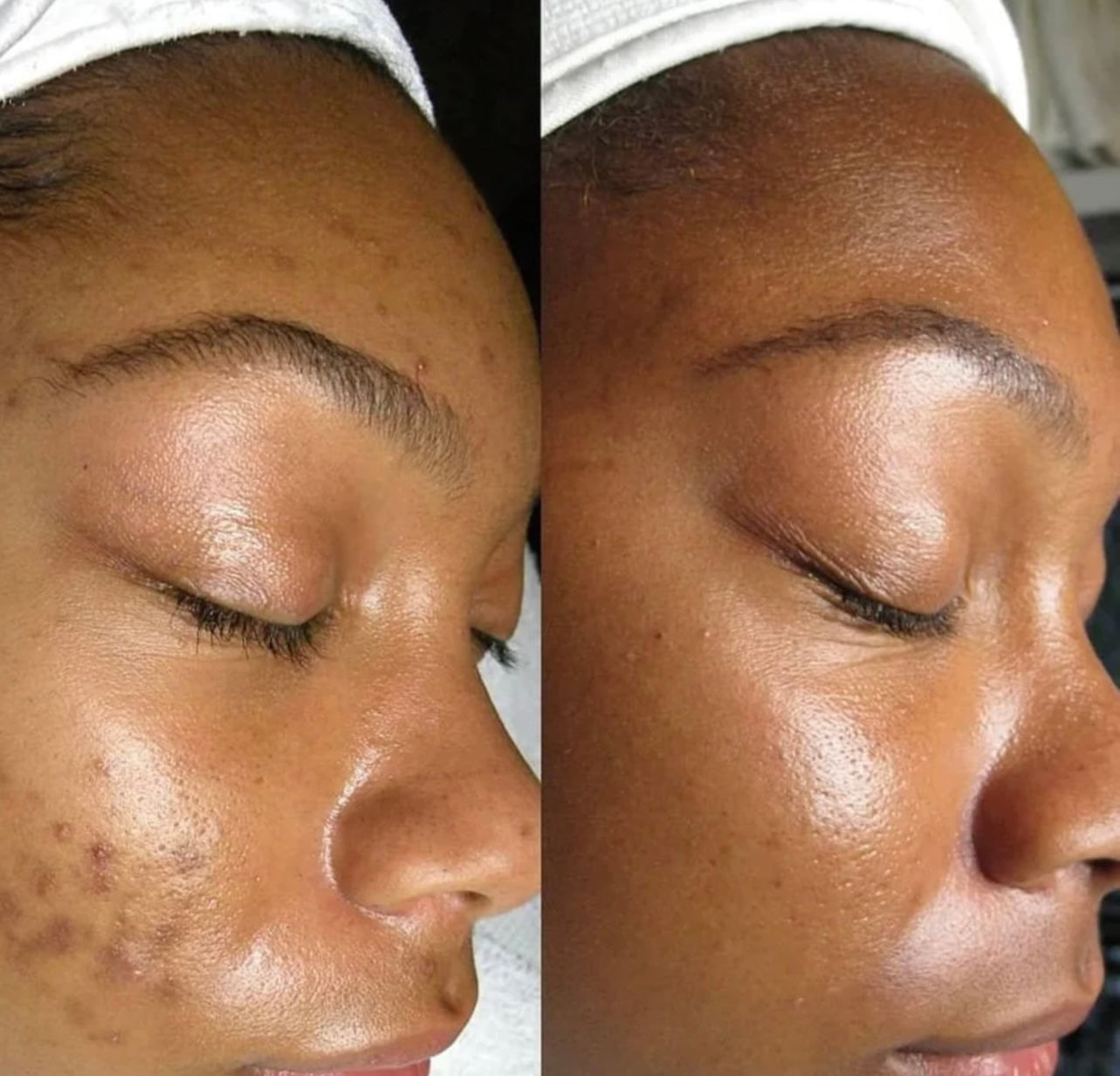 The Perfect Derma Chemical Peel W/ Post Treatment Care